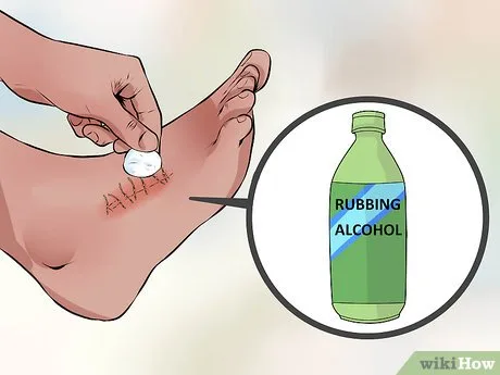 Nanosekání alkoholu na stehy po operaci nohy.
