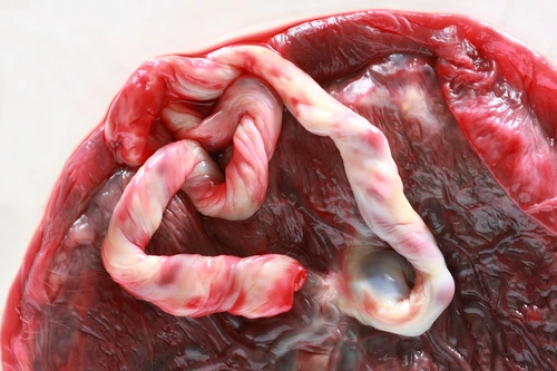 Placenta s pupečníkem připojeným k plodu na matčině straně.