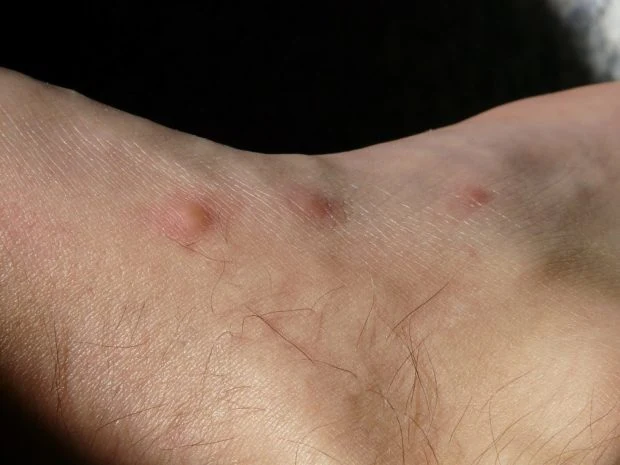 Kožní vyrážka s více štípanci od kousnutí štěnic.